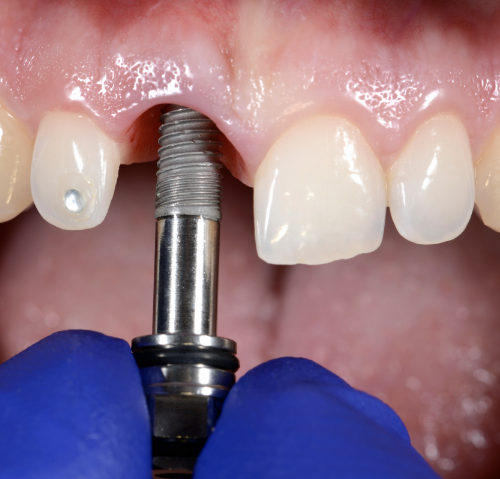 brenham tooth implant dental implant dental implants titanium tooth artificial tooth brenham